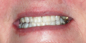 Whiter smile with bleaching and white fillings
