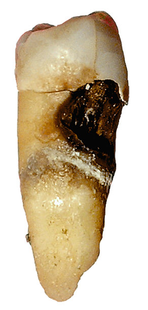 decayed molar tooth