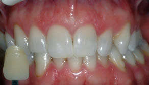 close up of smile with A3 shade tab
