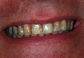 reeves smile case before