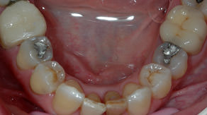 lower-arch-ortho-after.JPG