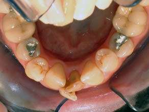 lower-arch-ortho-before.JPG