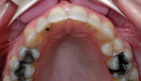upper-arch-ortho-after.JPG