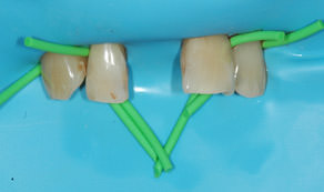 Rubber dam in place following extraction of damaged tooth
