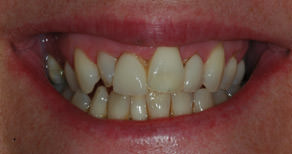 Gingival