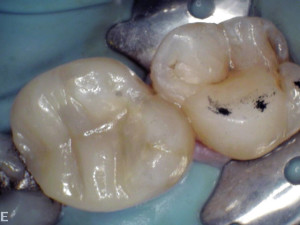 This photo shows the tooth rebuilt and ready for use