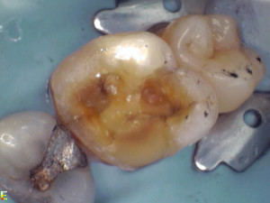 This photo shows the full extent of the cavity once the old amalgam filling and a further fractured cusp have been removed