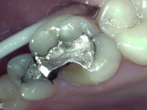 This photo shows the amalgam filling and the gap where the cusp has broken away from the rest of the tooth