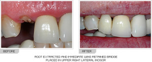 Before and After Wing Retained Bridges