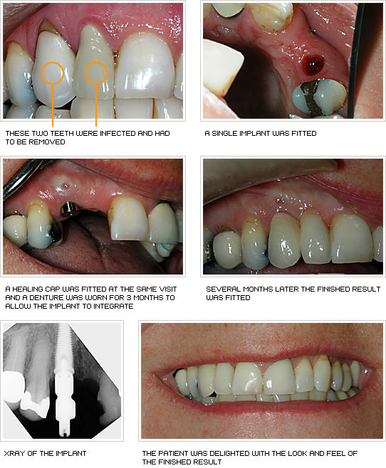 Before and After photos of dental Implant Techniques