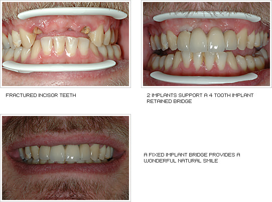 Before and After photos of implant retained bridges
