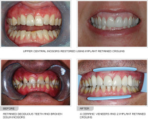 Before and after photos of implant retained crowns