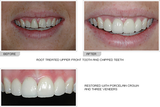 Before and After photos porcelain crowns