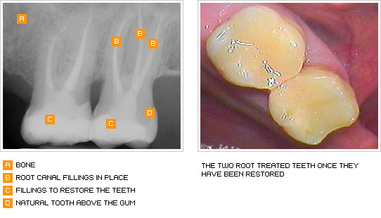 ba root canal dental pain
