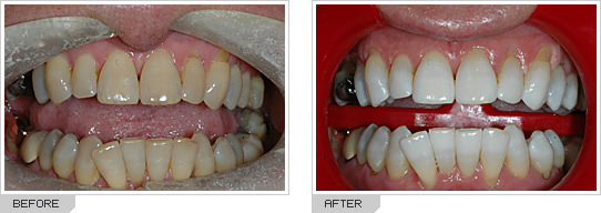 Before and After photos whitening teeth