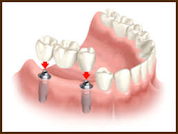 dental implant clinic implant bridge