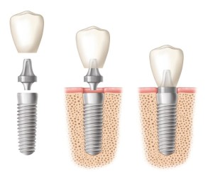 dental implant clinic implant components