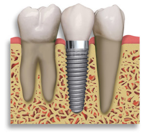 dental implant clinic implant in bone