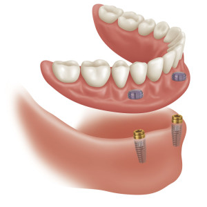 dental implant clinic implant supported denture
