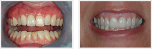 Implant Retained Crowns