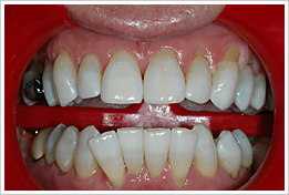 teeth whitening in Kent and East Sussex