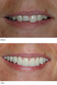 Smile Week Before and After