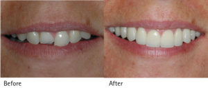 Smile Month Before and After