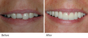 Smile Month Before and After