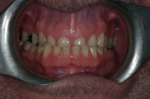 Build up of teeth with composite