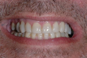 Direct Composites – white fillings
