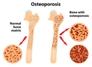 osteoporosis image