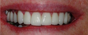 Smile Solutions After